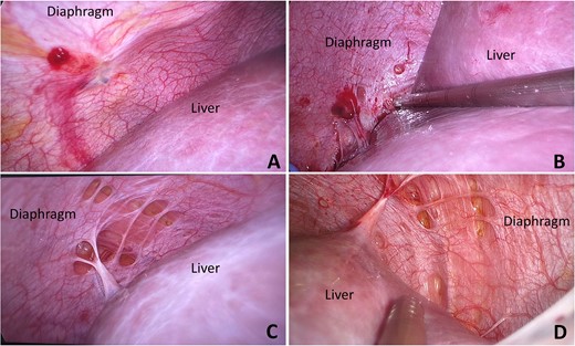 Hemorrhagic nodules scattered on peritoneal surface of right side of diaphragm, at dome (A) and posterior part (B). Multiple punctate lesions with peritoneal defect were found at dome of right diaphragm (C, D) These punctate lesions had no peritoneal coverage and diaphragmatic muscle fibers could be visualized.