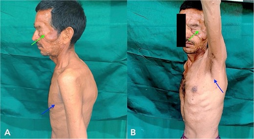 Clinical examination of the patient revealed localized Swelling over the left eyelid with consistency like a ‘Bag of worms’ and Café-au- lait macules and freckles over axillae (indicated with arrow).