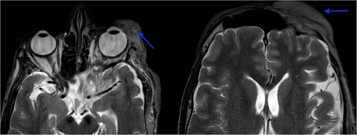 MRI orbit revealed enhancing skin thickening over the left frontal region, maxillary region, temporal region, supraorbital region, and over the left eyelids covering the eye.