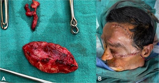 (A) shows excised neurofibromatosis tissue, which was sent for histopathology. (B) shows a postoperative image following closure.