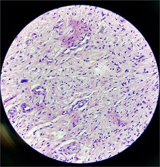 Histopathological examination revealed hypocellular proliferation of bland, slender to spindle-shaped cells with interspersed collagen.