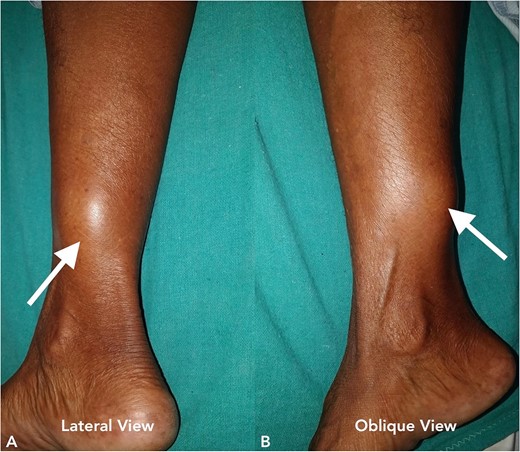 Clinical image of the patient’s swelling (marked with arrow) taken in lateral view (A) and oblique view (B).