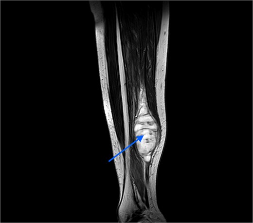 MRI image taken in coronal view, which was suggestive of a spindle-shaped mass lesion (indicated by arrow) located in the posterior compartment of the leg.