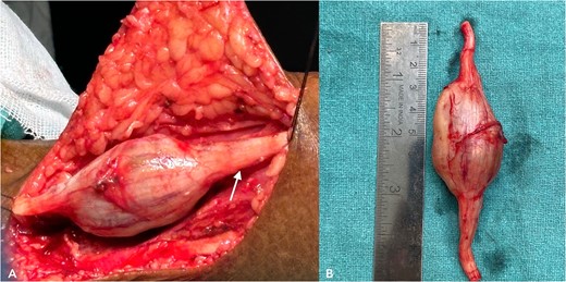 (A) shows an intra-operative image of the tumor, a part of the saphenous nerve (indicated by the arrow). (B) shows the excised specimen.