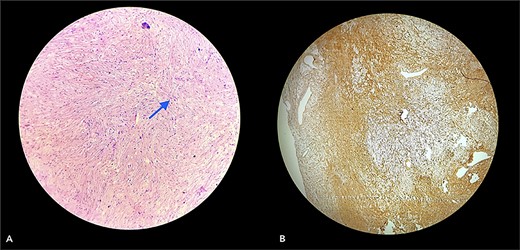 Section (A) shows wavy spindle cells with elongated nuclei and elongated cytoplasm within a fibrillary-type background with myxoid changes suggestive of PF. Section (B) of the IHC marker test shows scattered positivity in tumor cells, confirming the diagnosis. (S-100 = Positive and Ki67 = <10).