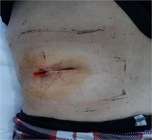 Site of lumbar incision with drain.