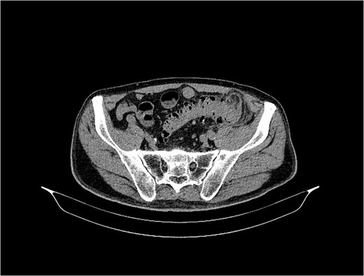 MSCT of the abdomen and pelvis shows the sigmoid colon and skin communication with air accumulation in the axial plane.