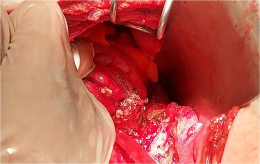 Intraoperative findings of fistula tract.