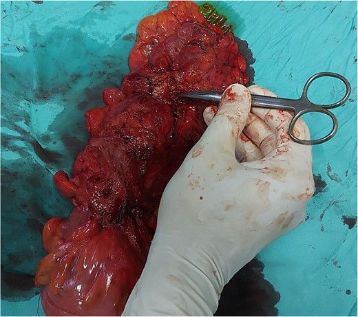 Specimen with marked place of fistula.