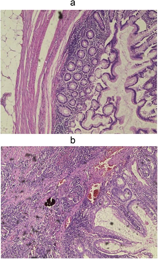 Wall of diverticulum in fat tissue (a) and acute purulent inflammation of diverticulum (b), H&E, 5x enlargement.