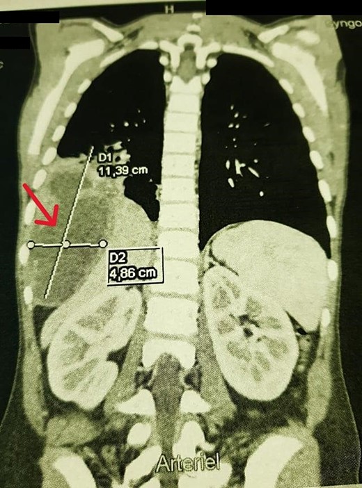 Coronal chest CT view 11 × 4 cm2 hydatid cyst that seems arising from the liver with possible intrathoracic rupture.