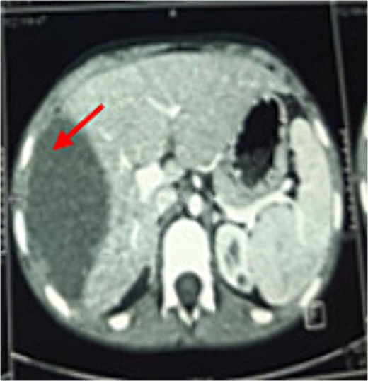 Axial chest CT view of the same hydatid cyst.