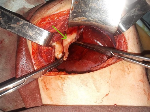 Intraoperative findings. (a) Location of the DHC during resection without adherence to the lung or abdominal viscera. (b) Germinative membrane of the DHC.