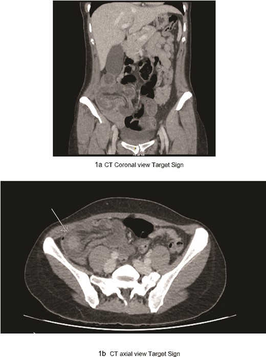 (a) CT coronal view target sign; (b) CT axial view target sign.