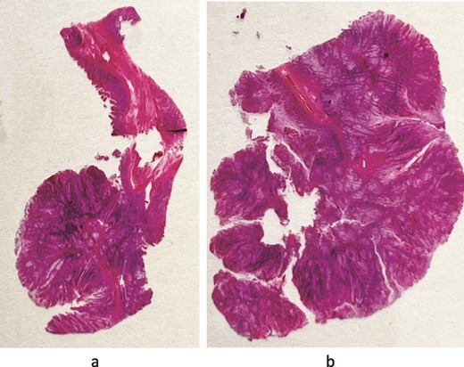 (a and b) Photography of the glass slide: they give an impression of the architecture of these hamartomatous polyps—nests of nondysplastic glands separated by arborizing strands of smooth muscle.