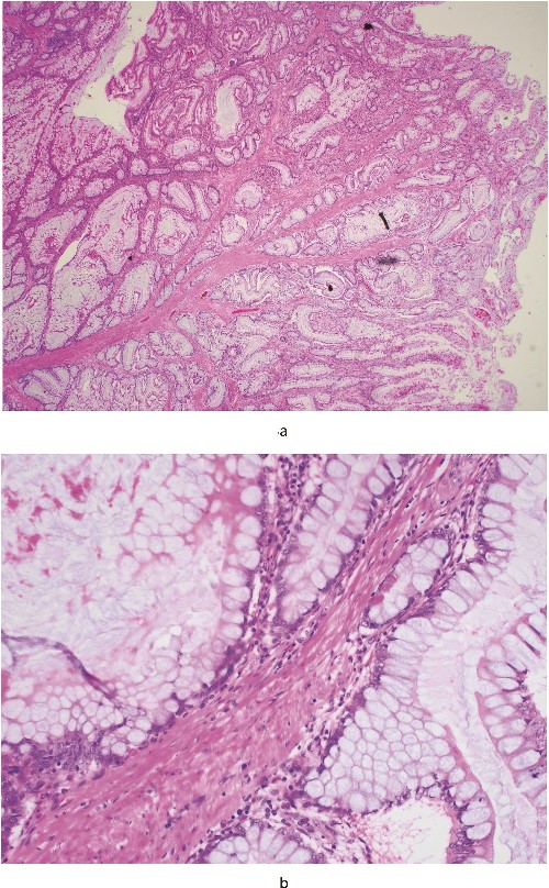 (a) (20×) is a low-power microscopic image of the polyp; the eosinophilic (pink!) strands of tissue running from the bottom left towards the centre, where they progressively divide, are the smooth muscle fibres and (b) (400×) is a high-power view of the epithelial cells—they have small round basal nuclei and abundant mucinous apical cytoplasm, and are nondysplastic.