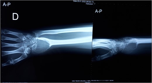 Plane anterior–posterior X-ray of the right forearm.