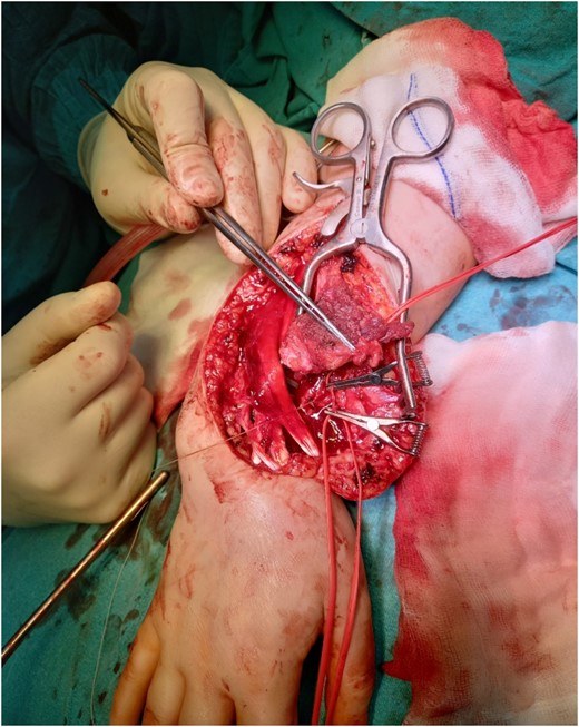 Reconstruction of the defect after resection of the GCTB of the distal radius and anastomosis of the vessels.