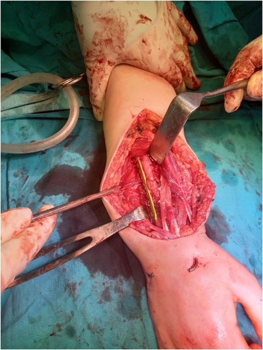 Graft fixation with plate and screws, and two Kirschner wires.