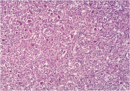 Microscopic appearance of the tumor, Ne-Eo, ×40.