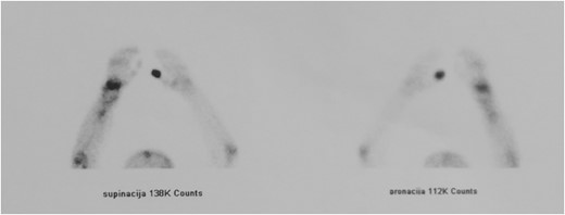 Bone scan confirmed the functionality of the graft.