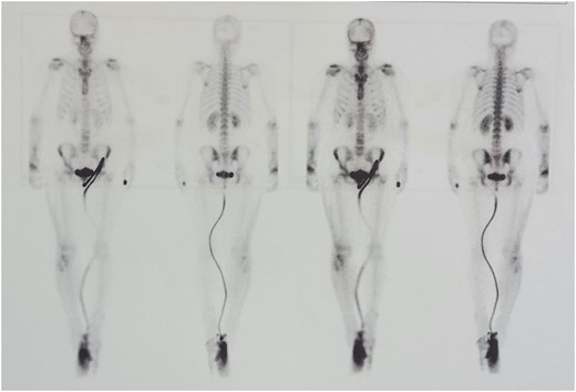 Bone scan confirmed the functionality of the graft.