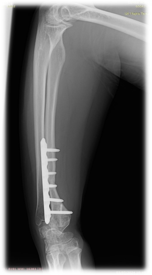 Follow-up X-ray of the right forearm 2 years after the surgery in profile plane