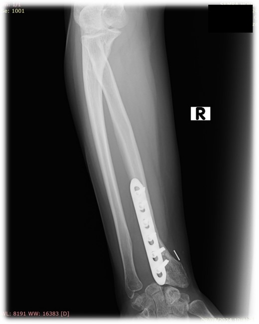 Follow-up X-ray of the right forearm 2 years after the surgery in anterior–posterior plane.