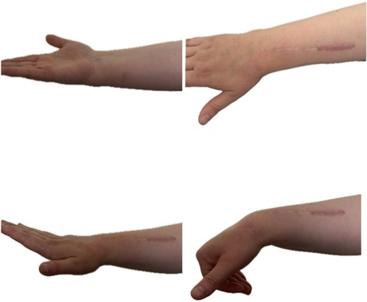 Range of motion in the wrist at 2-year follow-up.