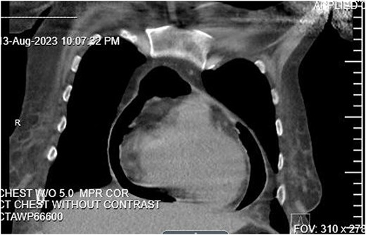 CT Abdomen pelvis showing moderate pneumopericardium observable from lower thorax.