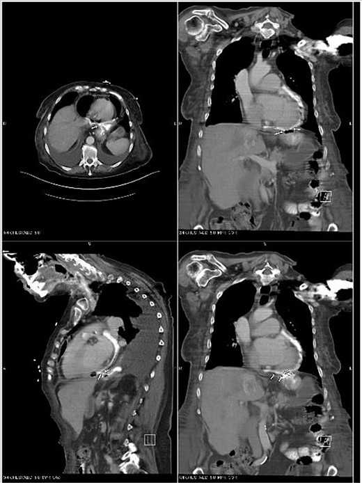 CT Chest with oral contrast demonstrating gastropericardial fistula.