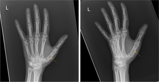 Frontal and oblique radiograph of the left hand showing a non-aggressive lytic lesion of the left 1st metacarpal bone with internal sclerosis.