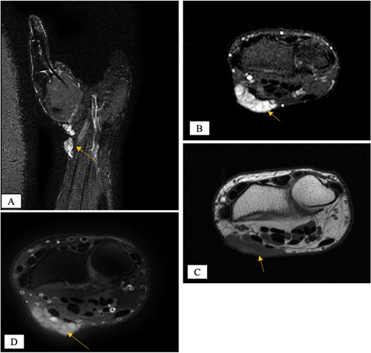MRI of the left distal forearm showing cutaneous and subcutaneous lobulated mass at the volar aspect of high T2 and low T1 signals with diffuse enhancement. (A) Coronal T2-weighted fat saturated image. (B) Axial T2-weighted fat saturated image. (C) Axial T1-weighted image. (D) Axial T1-weighted fat saturated image post gadolinium injection.