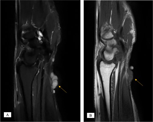 MRI of the left distal forearm showing cutaneous and subcutaneous lobulated mass at the volar aspect of high T2 and low T1 signals with diffuse enhancement. (A) Sagittal T2-weighted fat saturated image. (B) Sagittal T1-weighted image.