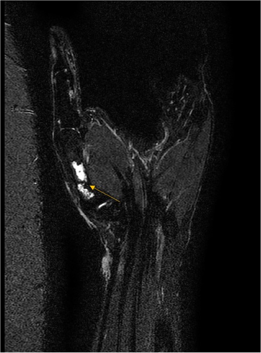 MRI coronal T2-weighted fat saturated image showing intraosseous lesion of high T2 signal in the first metacarpal bone.