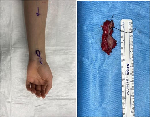 Left distal forearm multi-lobulated soft tissue lesion.