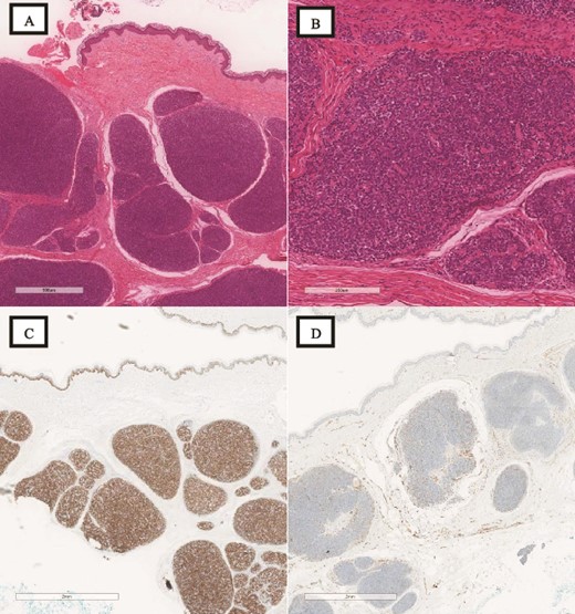(A) H&E, low magnification (4×): the subepidermal proliferation of the basophilic epithelial cells appears to be organized in a “jigsaw puzzle” pattern rather than an irregular multinodular pattern. (B) H&E, high magnification (20×): although features with spiradenocylindroma are encountered, the dual cell population with thick intratumoral hyaline stroma and the “jigsaw puzzle” pattern, predominate mostly the Cylindroma component. (C) P63 immunostain: the solid pattern of the basaloid cells in the myoepithelial cell population is highlighted. (D) CD31 immunostain: the mostly peripheral vascular pattern of cylindroma rather than intratumoral vessels is highlighted. The overall tumor’s morphology has spiradenocylindroma features with a predominant cylindroma pattern.