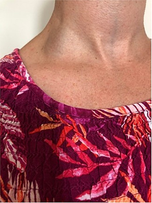 EJV aneurysm without Valsalva manoeuvre.