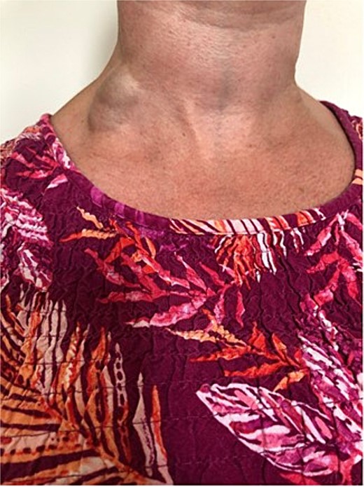 EJV aneurysm with Valsalva manoeuvre.