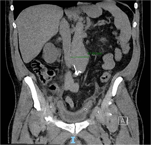 Frontal CT of the abdomen and pelvis demonstrating 4.79 cm AAA.