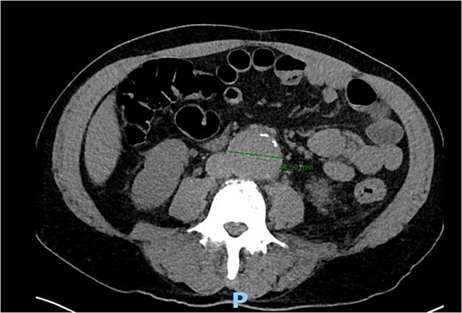 Axial CT of the abdomen and pelvis demonstrating 4.86 cm AAA.