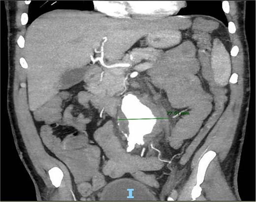 Frontal CT angiography of the abdomen and pelvis demonstrating 7.75 cm AAA with fat stranding.