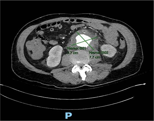 Axial CT angiography of the abdomen and pelvis demonstrating 7.7 cm AAA with fat stranding.
