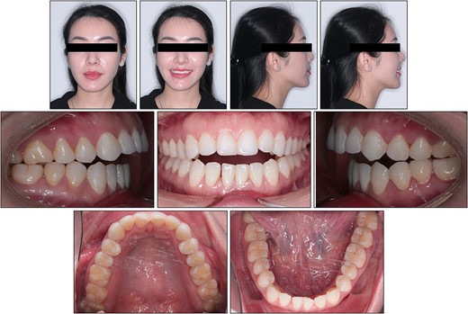 Pretreatment facial and intraoral photographs.