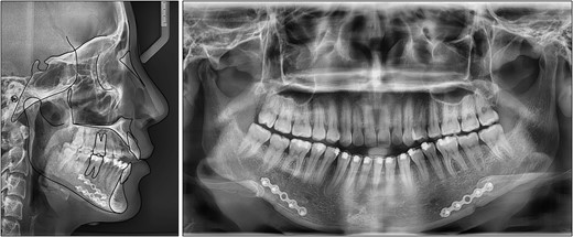 Pretreatment cephalometric and panoramic radiographs.