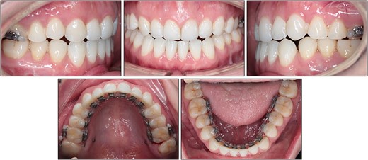 Mini-screws for the entire maxillary arch distalization.