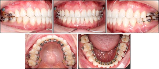 Maxillary molar intrusion with buccal and palatal mini-screws.