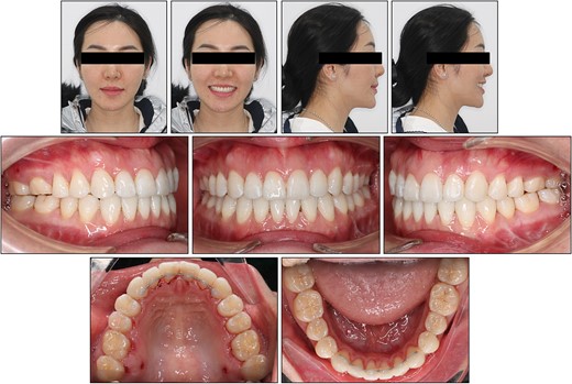 Posttreatment facial and intraoral photographs.