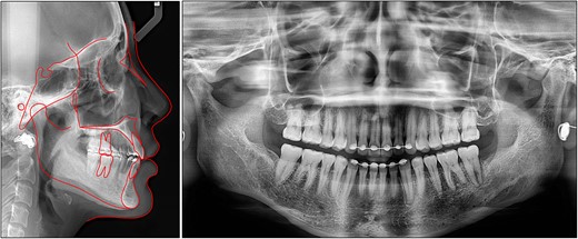 Posttreatment cephalometric and panoramic radiographs.