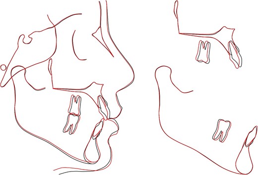 Overall and regional cephalometric superimpositions: black, pretreatment; red, posttreatment.